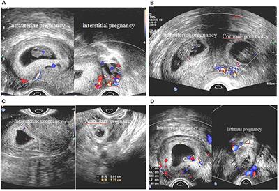 Frontiers | Heterotopic Pregnancy Secondary To In Vitro Fertilization ...